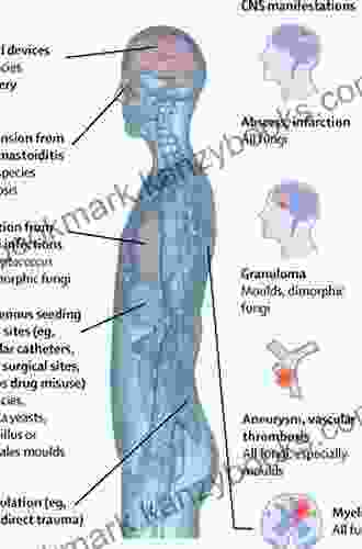 Fungal Infections Of The Central Nervous System: Pathogens Diagnosis And Management